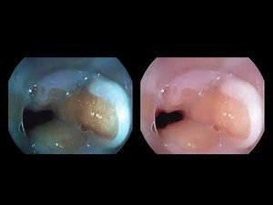 Examining the normal Z line