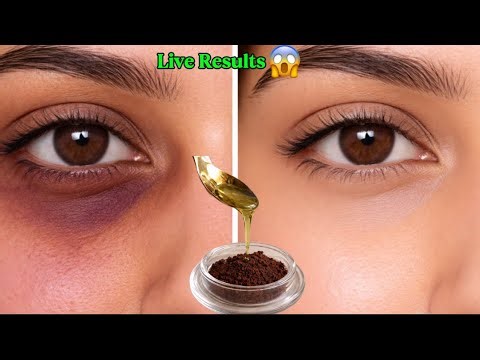 Say Goodbye to Dark Circles Forever Get Bright Under Eyes Naturally || Dark Circles Removal At Home✨