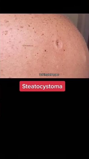 Dropping some knowledge on sebaceous cysts 👩🏻 🔬 #drpimplepopper #popaholics