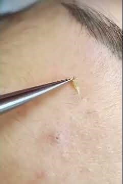 Abscess cysts pimples blackheads popped