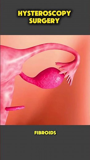 How Hysteroscopy Surgery Is Done | Step-by-Step Explanation #Hysteroscopy #medicaleducation