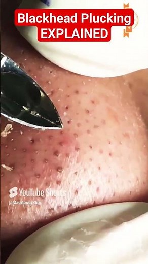 World Record BLACKHEAD PLUCKING #shorts