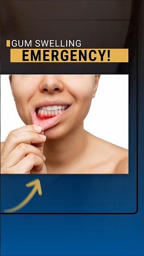 🚨 Why a Tooth Abscess Is a True Emergency! 🚨