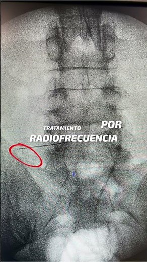 SINDROME BERTOLOTTI: Radiofrecuencia megaapofisis