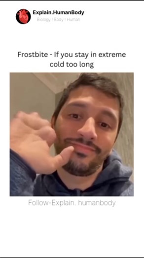 Biology ! Body ! Human | Severe frostbite in fingers occurs when the skin and underlying tissues freeze due to prolonged exposure to extreme cold. In advanced... | Instagram