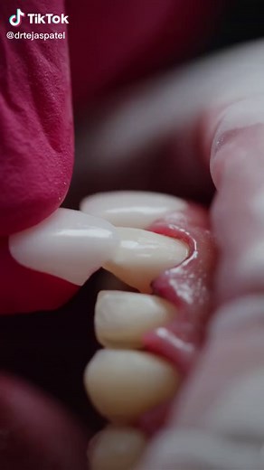 The final steps of the veneer process are so satisfying! #veneers #moreyouknow #teeth #newsmile #teethwhitening #cosmeticdentist #fyp #viralvideo #teethcare