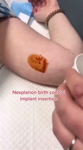 Nexplanon is a sub dermal birth control implant that goes into the non-dominant arm