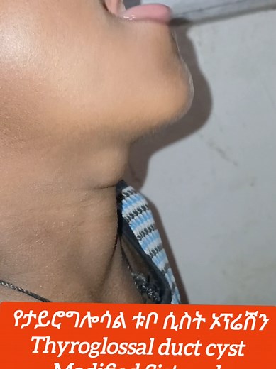 #creatorsearchinsights #Thyroglossalductcyst _Modified sistrunk procedure#viral #foryou #fypp