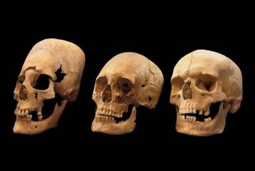 Foreign eggheads: Pointy-skulled women were immigrant brides