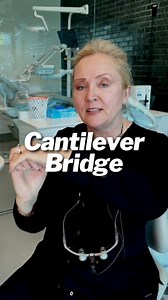 😯🦷What is a cantilever bridge?This unique system utilizes adjacent teeth as anchors, with a central fake tooth creating a seamless smile.😄Whether used as a full bridge or a half bridge, it offers versatile options for replacing missing teeth. 🦷👉🏻However, proper placement is crucial for ensuring long-term success and functionality. Follow me for more dental insights!✔️#dentalcareworld #oralcaretips #holisticdentistry | Natural and Cosmetic Dentistry