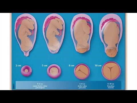 Progreso | Trabajo de Parto
