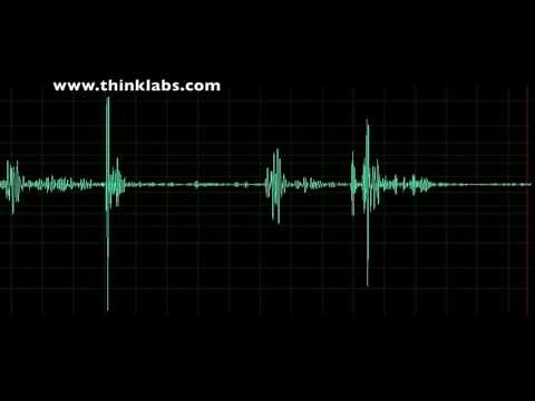 Pulmonary Stenosis- mild