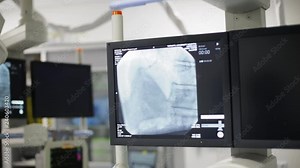 Monitor screen in radiology during heart surgery.