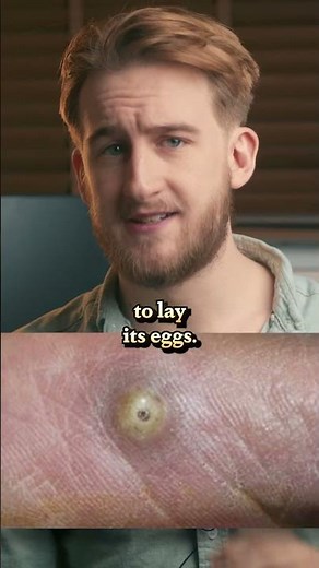 Awful Parasites: The Jigger Flea