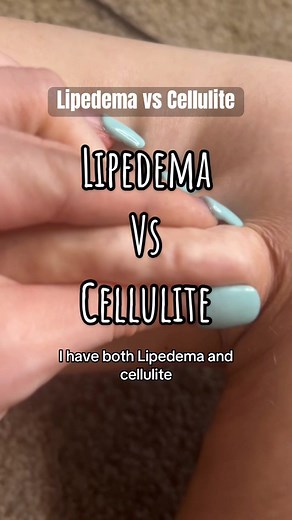 Understanding Lipedema vs Cellulite Differences