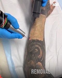 716K views · 2.1K reactions | The process of tattoos getting removed is so engrossing ⚡️ | GOODLAD | Facebook