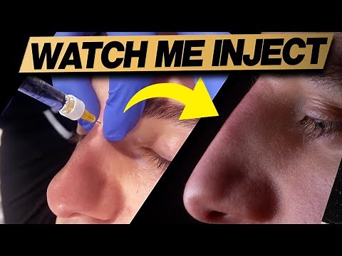 2 Minute Nose Straightening With Dermal Fillers (Before and After)