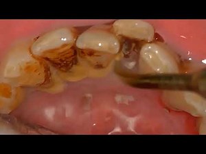 Heavy Calculus Tartar Removal - Dental Calaculus Removed with Ultrasonic Scaler #32 🦷 DentalHealth