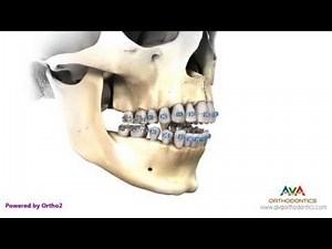 Surgical Orthodontic Treatment for Openbite - Maxillary Impaction