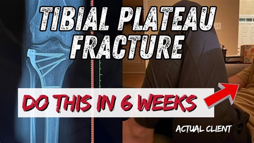 Tibial plateau fracture patients often do well in the early phase of care, especially when managed by skilled surgeons and physiotherapists. The challenge rarely lies in the initial clinical… | The Complete Recovery Program for Tibial Plateau, Leg, and ORIF Surgeries
