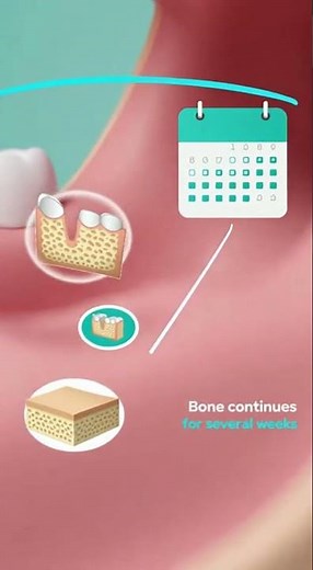 🦷 How Long Does It Take to Heal After a Tooth Extraction?