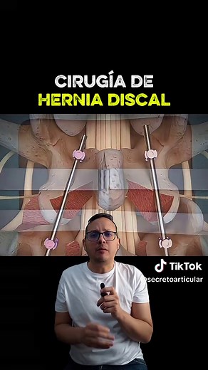 Cirugía de Hernia Discal: Técnicas y Recuperación Efectiva