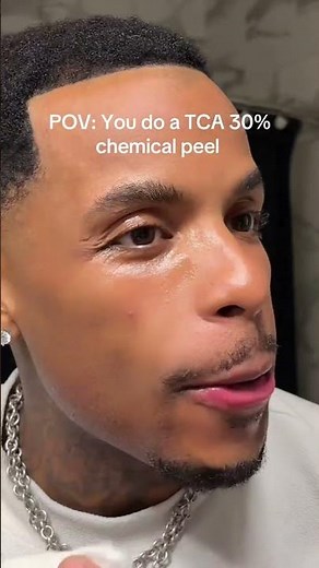 A TikToker's At-Home 30 Percent TCA Peel Has Gone Viral—and Doctors Are Worried