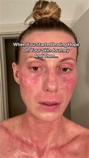 When you started losing hope on your eczema journey and then… ❤️‍🔥