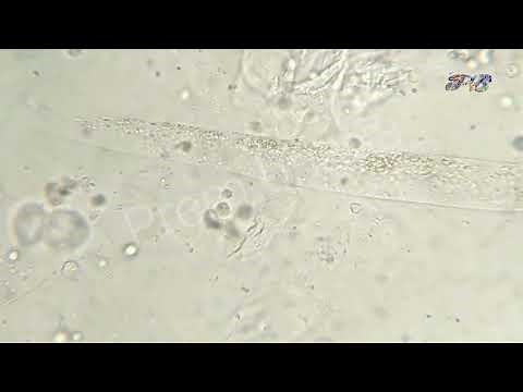 Finely granular casts and hyaline casts seen in microscopic urine slide || casts in urine