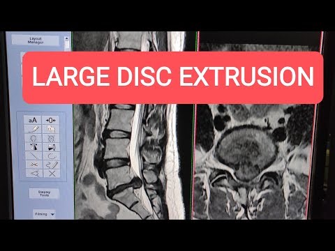 Large Disc Extrusion - MRI of Lumbar Spine on GE 1.5 Tesla.