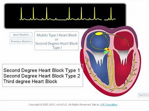 ECG Rhythm Review: AV Blocks