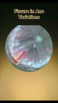 FISSURE IN ANO Variations/stages/types#medical #fissure #piles