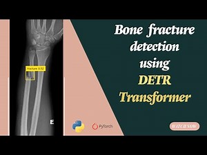 Object detection Using Detection Transformer (Detr) for Bone fraction dataset