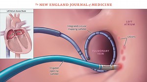 Atrial fibrillation is a disturbance of heart rhythm that can lead to blood clots, stroke, and other heart-related complications. Watch a new Double Take video, “Atrial Fibrillation — What Is It and How Is It Treated?” to learn from renowned cardiology experts as they discuss the history, diagnosis, and treatment of atrial fibrillation, with a specific focus on catheter ablation therapy. Watch at https://nej.md/3S2wKH3 | The New England Journal of Medicine