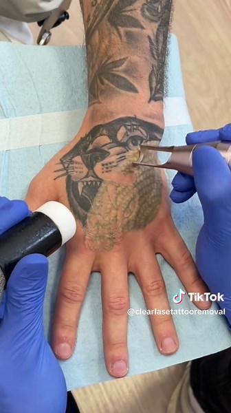 Laser Tattoo Removal Process Explained
