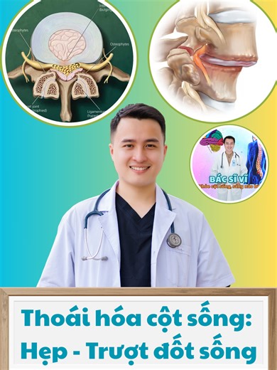 🌟Thoái hóa cột sống thắt lưng (phần 1): 💥Tổng quan Thoái hóa cột sống thắt lưng là gì? 💥Hội chứng hẹp ống sống 💥Trượt đốt sống 💥Các yếu tố nguy cơ Tại sao tôi lại bị thoái hóa cột sống thắt lưng? #HẹpỐngSống #truotdotsong #cotsonglung #thoaihoacotsong #hepongsong #thoatvidiadem