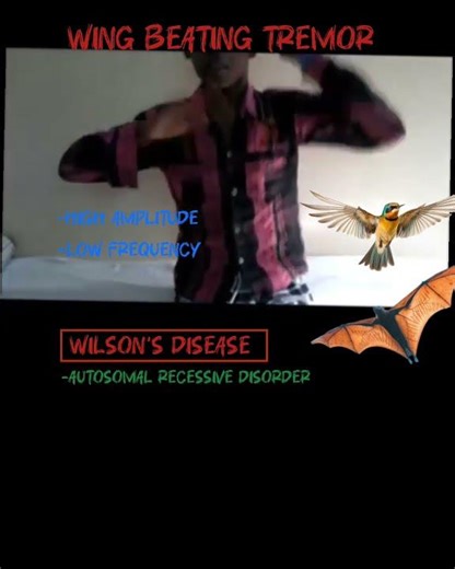 Wing Beating Tremor - Tremor in Wilson's disease