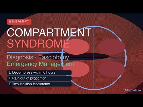 Compartment Syndrome: Diagnosis, Fasciotomy & Emergency Management