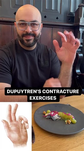 🚨DUPUYTREN’S CONTRACTURE EXERCISES 🚨 - 🧠 Dupuytren contracture is typically painless and causes one or more fingers to tighten up or bend toward the palm of the hand (most commonly the ring and little finger). Tissue adhesions form in the fascia under the skin and make it difficult or impossible to straighten the hands and fingers over time. - 📚Risk factors for developing Dupuytren’s Contracture: ✅ Over the age of 50 ✅ More common and more severe in men ✅ Northern European descent or family 