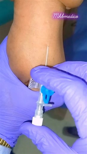 22G Blue Cannula Insertion Step by Step 💉 | IV Cannulation | Nursing Skills #shorts
