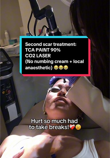 Acne Scar Treatment: TCA Cross and CO2 Laser Experience