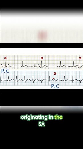 ECG: Spotting PJCs vs. PACs: Quick Cardiac Rhythm Guide! #shorts