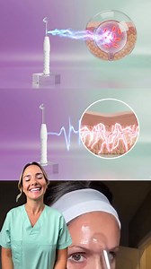 The AURA Wand was designed to simplify everything. This one device is your 3-in-1 powerhouse, using the same high-frequency technology found in high-end salons. First, it uses a targeted microcurrent to painlessly neutralize acne-causing bacteria, calming inflammation and stopping future breakouts. Second, it energizes the skin, boosting circulation and collagen production to naturally soften fine lines and firm your complexion. Finally, the comb attachment stimulates follicles and energizes the