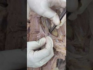 Inguinal Hernia
