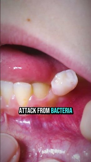 Why Your Gums Are Bleeding #dentalcare