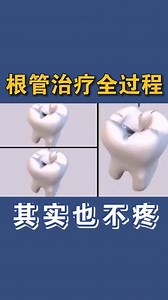根管治疗全过程.根管治疗你觉得疼吗？3D全过程带你了解！ #根管治疗是什么 #什么是根管治疗 #根管治疗很痛吗 #根管治疗 #惠州根管治疗