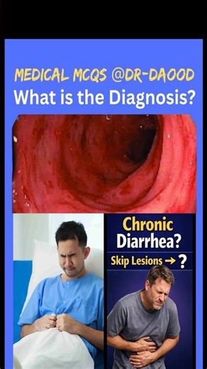 Colonoscopy Findings That Diagnose Crohn’s Disease. MCQ Explained. #mcq #mcqs #mcps #usmle