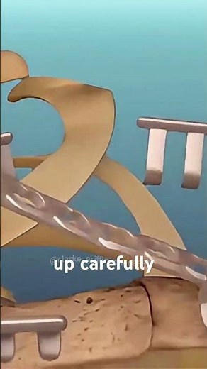 Broken Collarbone Treatment Explained (3D Animation)#ClavicleSurgery #BonePlating #OrthopedicSurgery