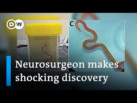 Neurosurgeon removes live worm from woman's brain in world-first discovery | DW News