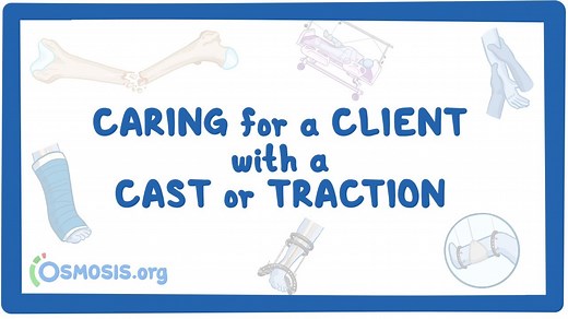Caring for a client with a cast or traction: Video, Causes, & Meaning | Osmosis
